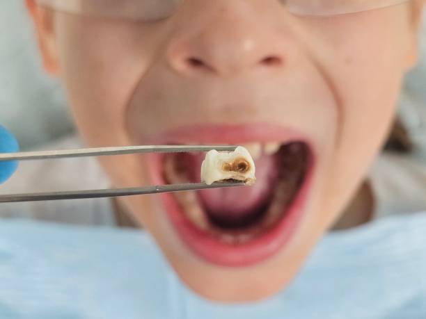Best Emergency Dental Care for Broken or Chipped Teeth in Dublin, OH