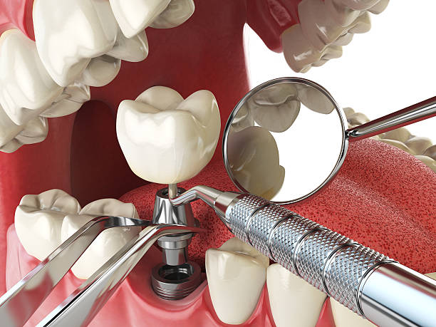 Best Emergency Treatment for Dental Infections or Abscesses in Dublin, OH